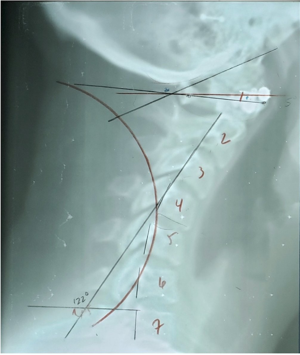 Lateral cervical X-ray showing severely abnormal curve with subluxation pattern at C5 C6 C7 before corrective care, Rochet Family Chiropractic Royal Palm Beach