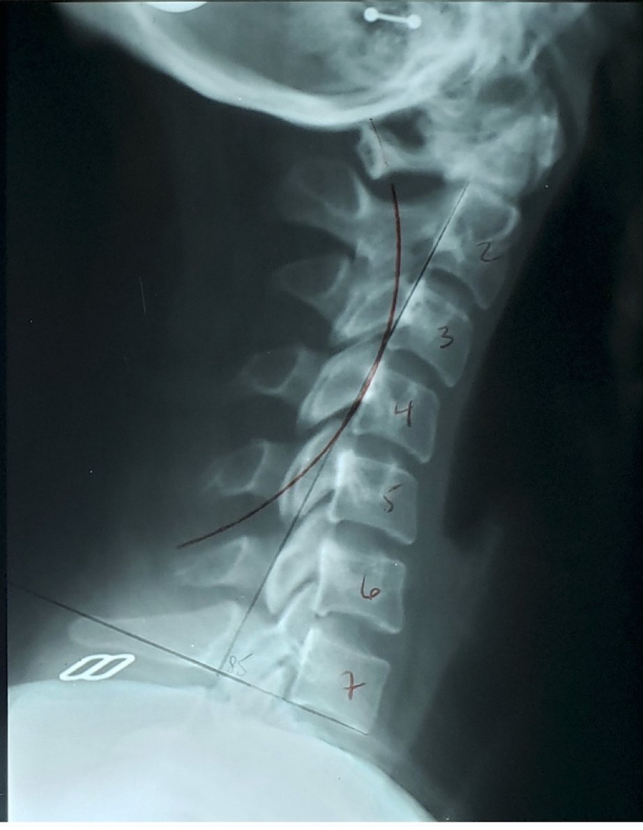 Follow-up lateral cervical X-ray showing curve improved to 85 degrees after 6 months of structural correction at C5 C6 C7, Rochet Family Chiropractic Royal Palm Beach