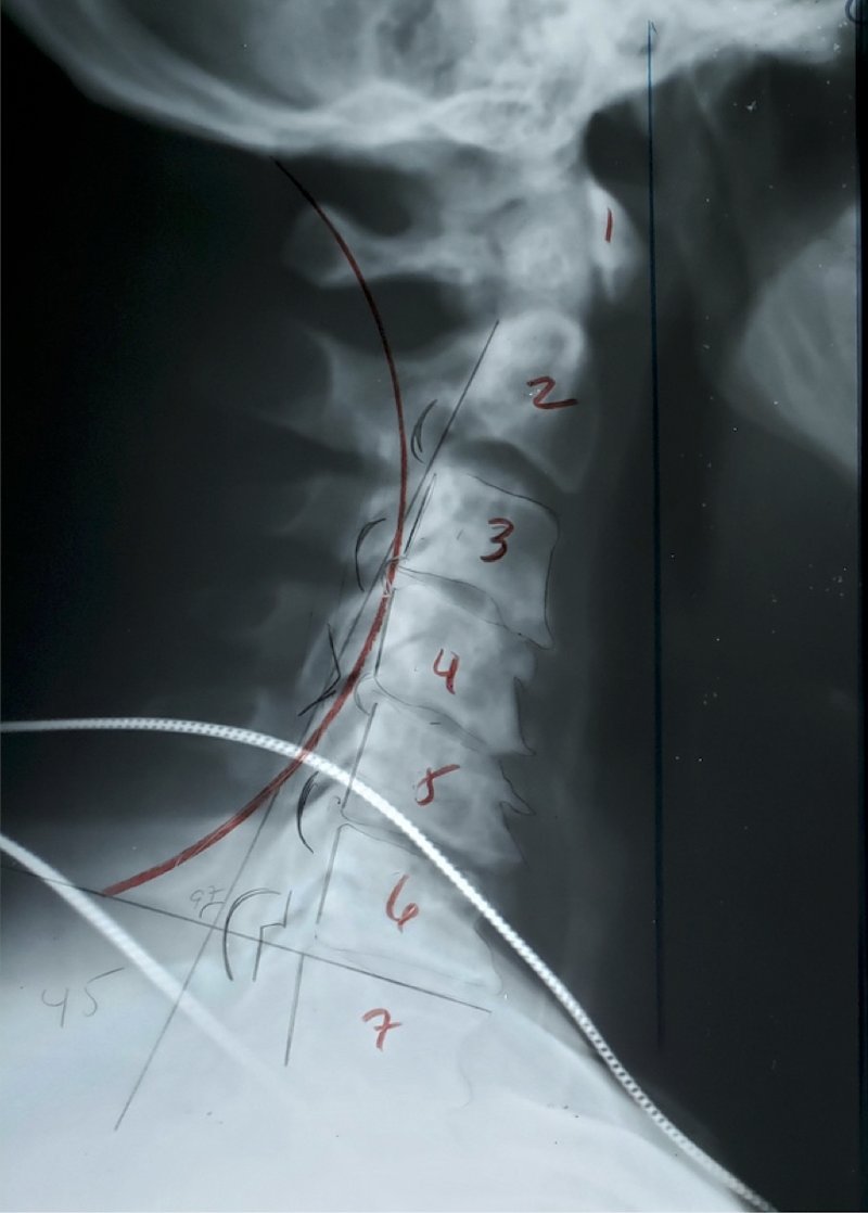 Initial lateral cervical X-ray showing reversed cervical curve, severe forward head carriage, and vertebral degeneration following motorcycle accident trauma, Rochet Family Chiropractic Royal Palm Beach