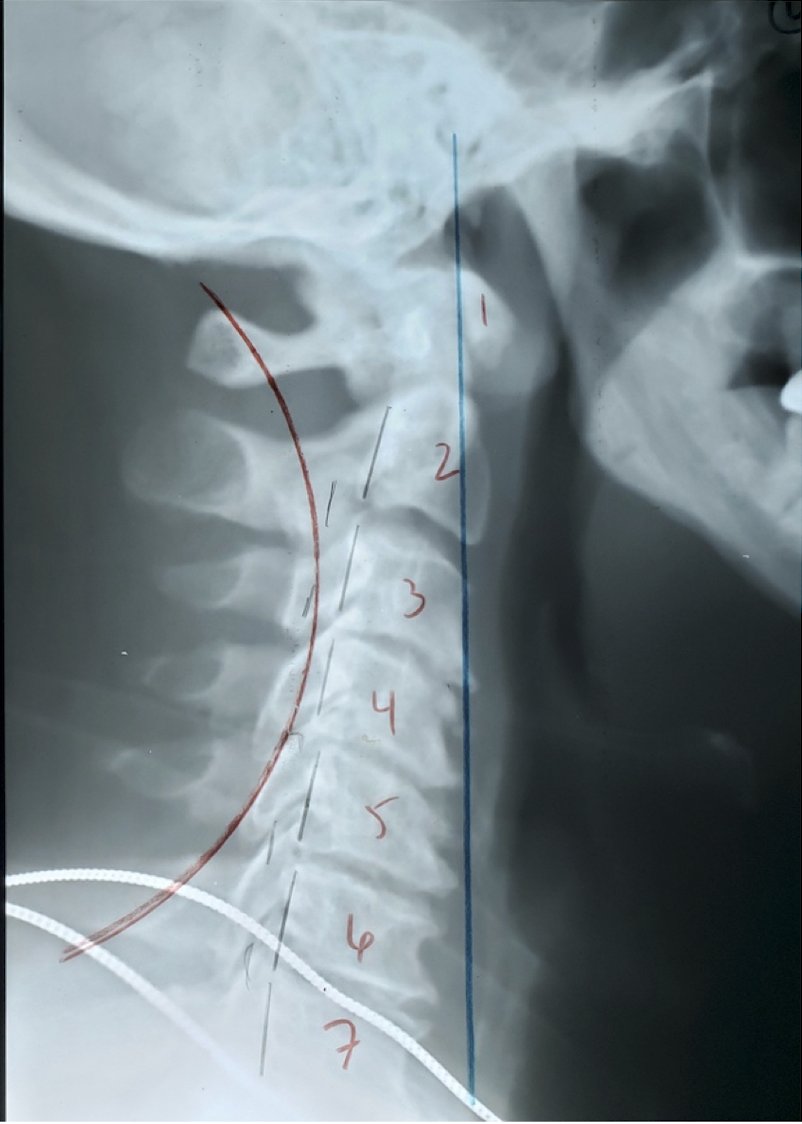 Follow-up lateral cervical X-ray showing straightened cervical curve and improved head carriage after 6 months of corrective chiropractic care, Rochet Family Chiropractic Royal Palm Beach
