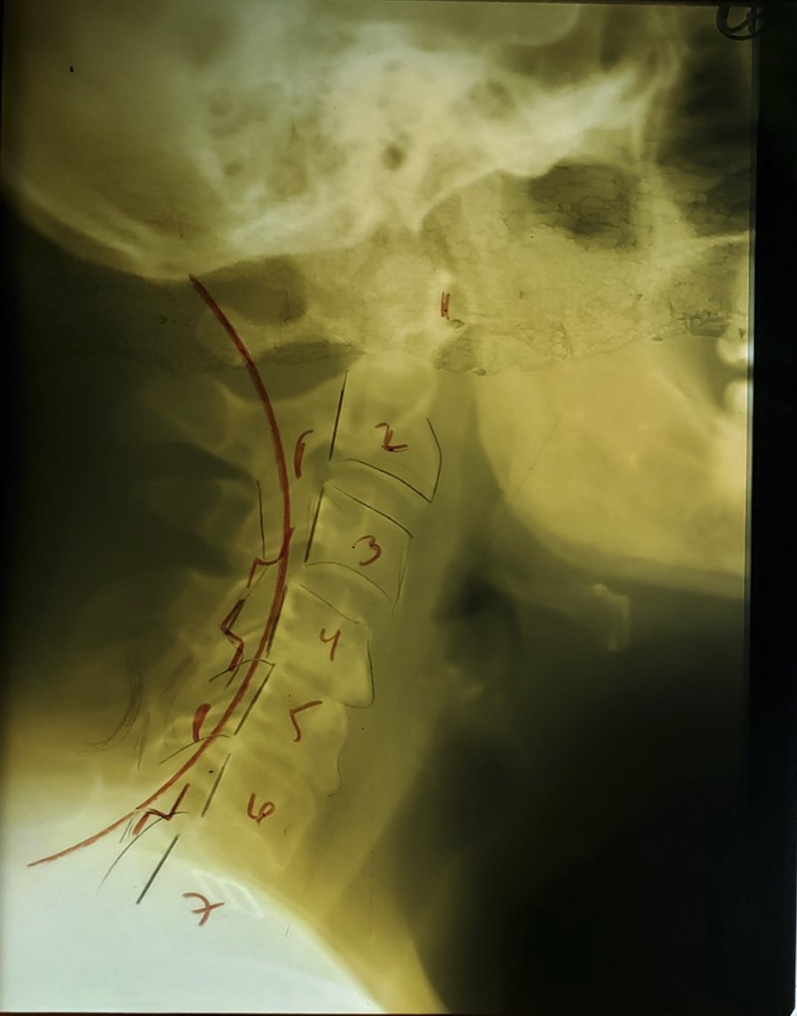 Initial lateral cervical X-ray showing vertebral stagger at C4 through C7 with moderate spondylosis and spinal cord compression, Rochet Family Chiropractic Royal Palm Beach