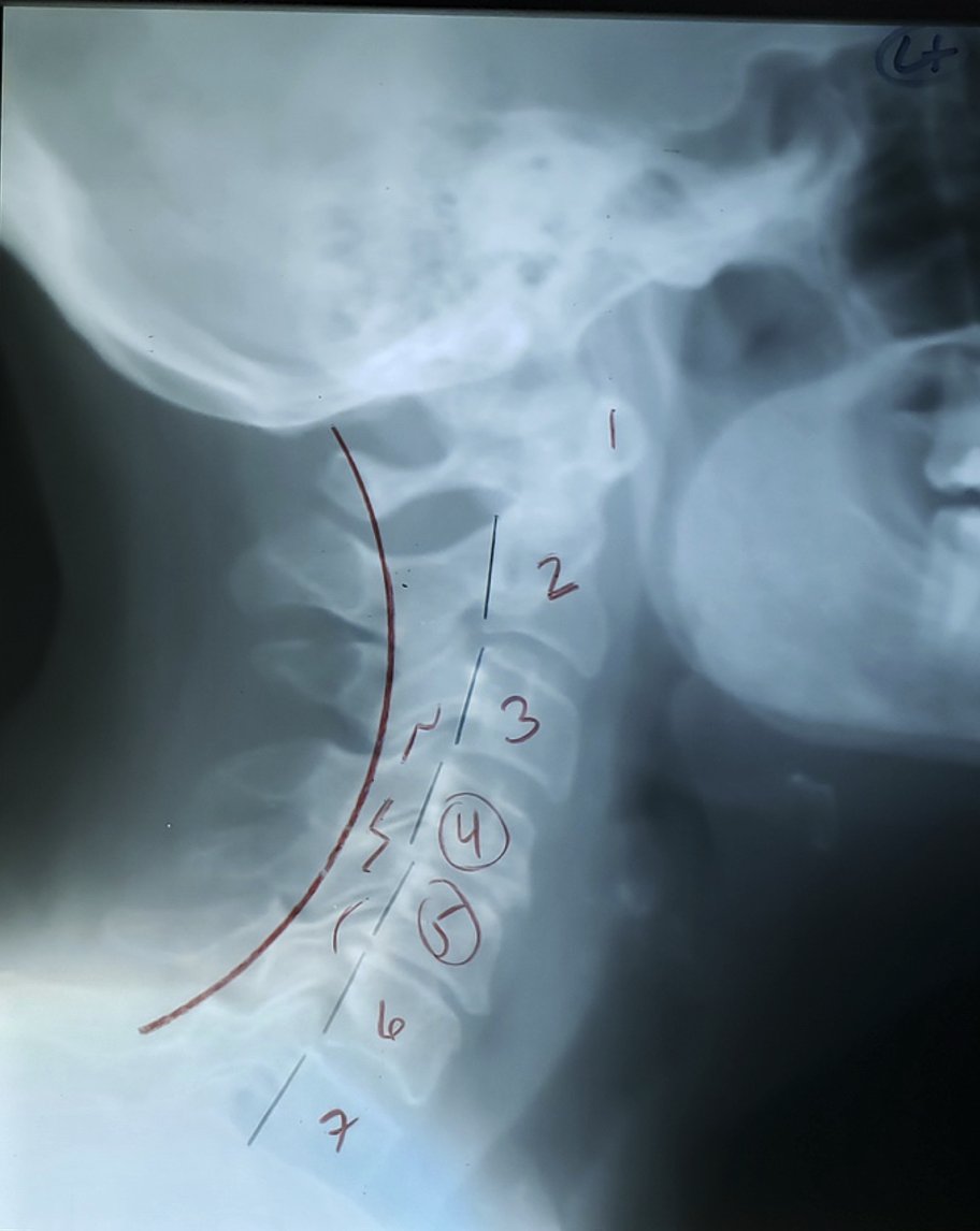 Follow-up lateral cervical X-ray showing improved vertebral alignment at C5 C6 C7 with significant reduction in spinal cord compression after corrective care, Rochet Family Chiropractic Royal Palm Beach