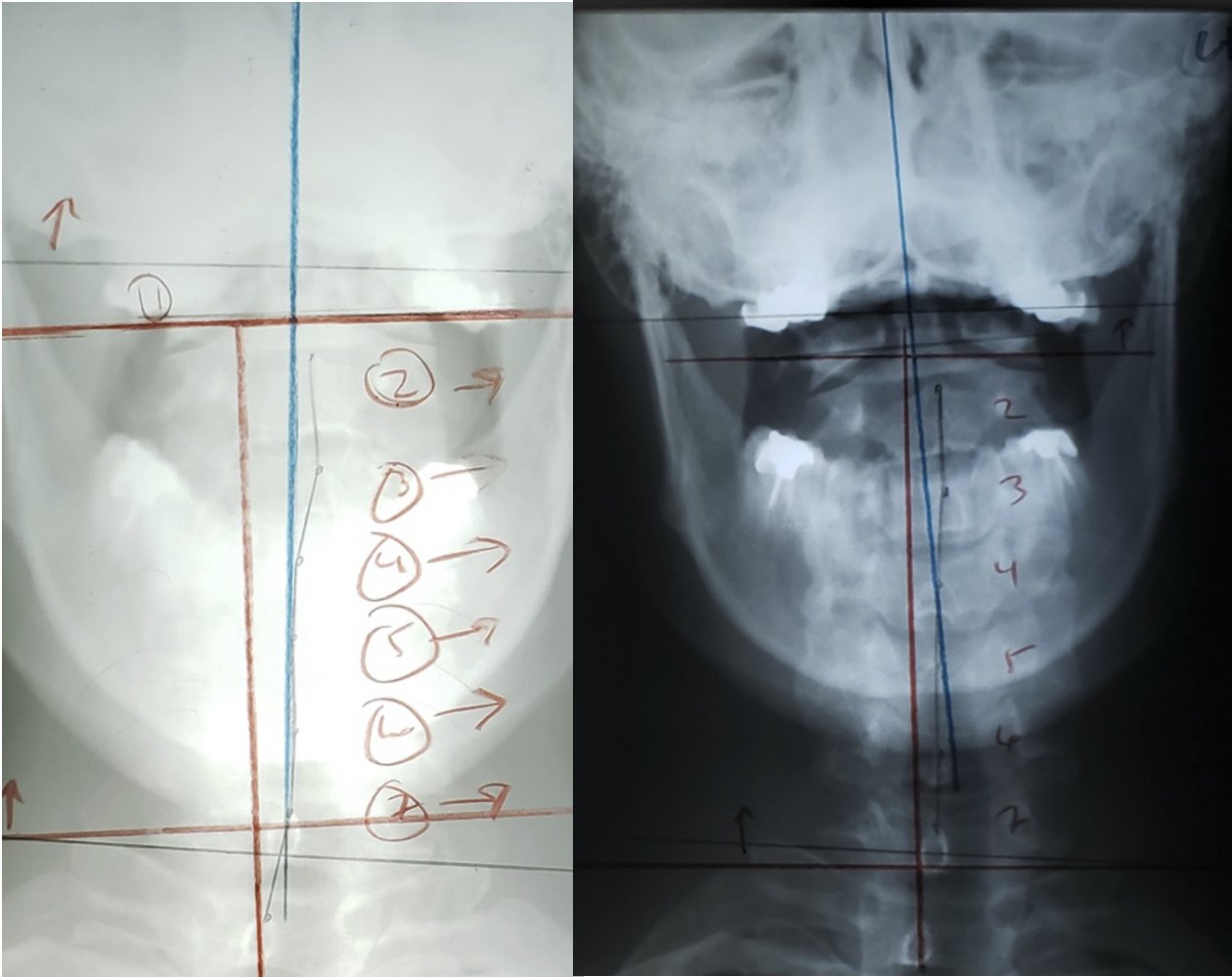 AP cervical X-ray before and after showing improved head and neck positioning after subluxation correction, Rochet Family Chiropractic Royal Palm Beach