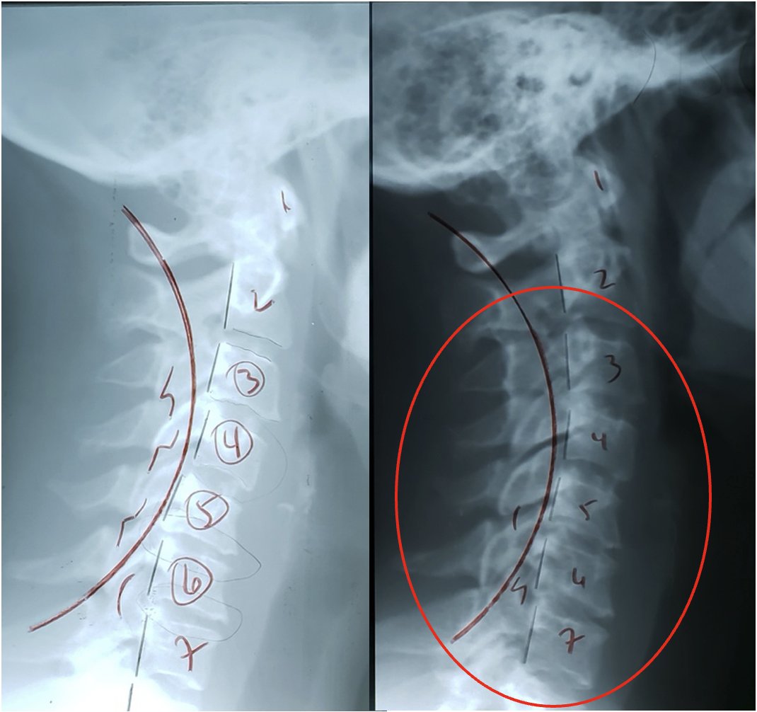Lateral cervical X-ray before and after showing stair-step subluxation correction and improved cervical curve, Rochet Family Chiropractic Royal Palm Beach