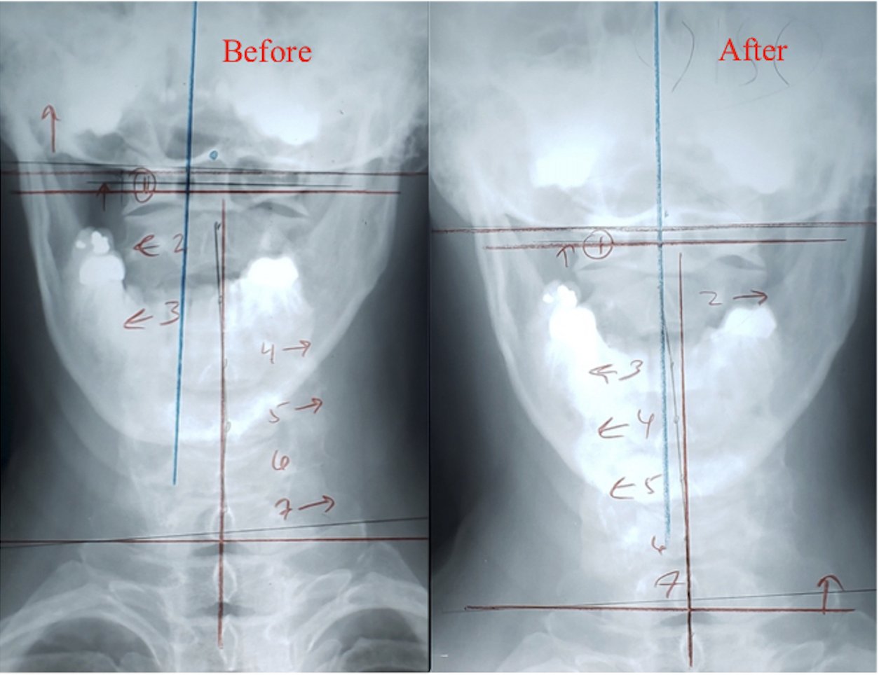 AP cervical X-ray before and after subluxation correction — Rochet Family Chiropractic, Royal Palm Beach FL