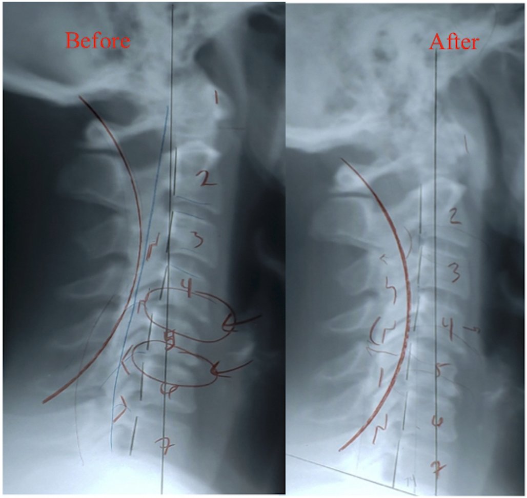 Lateral cervical X-ray before and after subluxation correction — Rochet Family Chiropractic, Royal Palm Beach FL