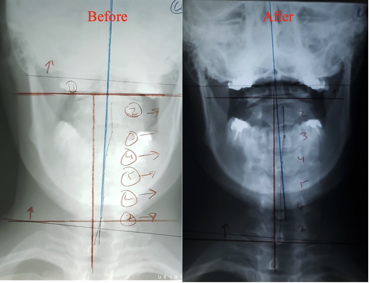 AP cervical X-ray showing head tilt correction after 3 months of structural chiropractic care — Rochet Family Chiropractic, Royal Palm Beach FL