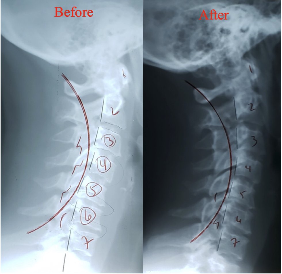 Lateral cervical X-ray showing structural correction after 3 months of corrective spinal care — Rochet Family Chiropractic, Royal Palm Beach FL