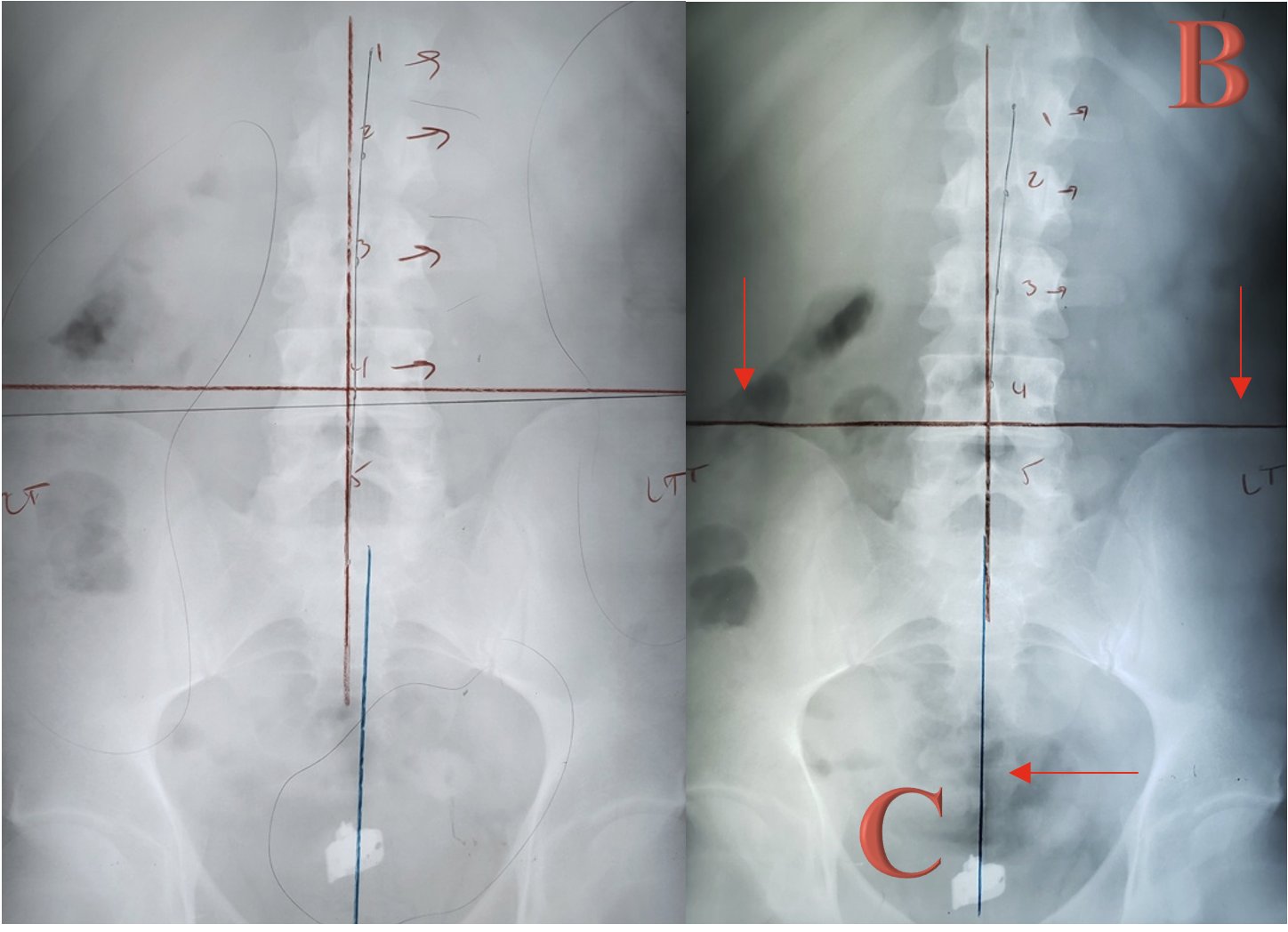 AP lumbar X-ray showing pelvic rotation correction and L1–L4 alignment improvement — Rochet Family Chiropractic, Royal Palm Beach FL