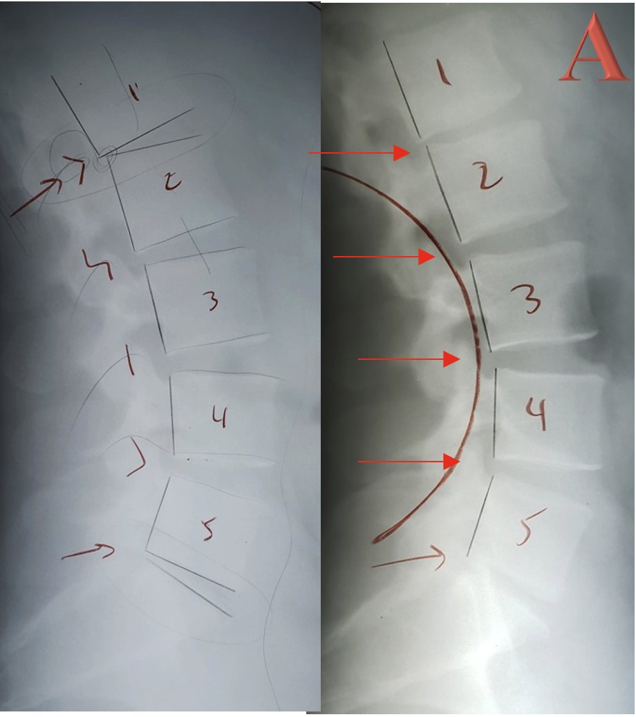 Lateral lumbar X-ray showing curvature improvement after structural chiropractic correction — Rochet Family Chiropractic, Royal Palm Beach FL