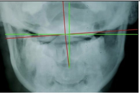 AP cervical X-ray initial — Rochet Family Chiropractic Royal Palm Beach FL