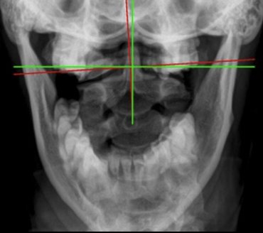 AP cervical X-ray re-evaluation after structural correction — Rochet Family Chiropractic Royal Palm Beach FL