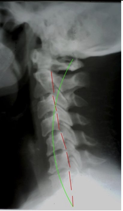 Lateral cervical X-ray initial showing reversed curve — Rochet Family Chiropractic Royal Palm Beach FL