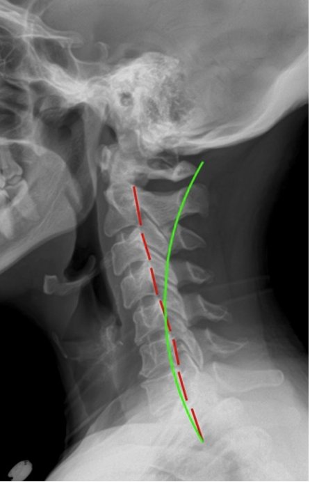 Lateral cervical X-ray re-evaluation showing curve restoration — Rochet Family Chiropractic Royal Palm Beach FL