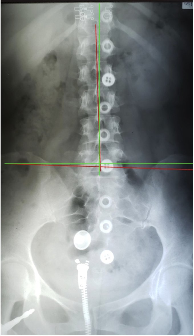 AP lumbar X-ray initial showing lumbar subluxation and AI Sacrum displacement — Rochet Family Chiropractic Royal Palm Beach FL