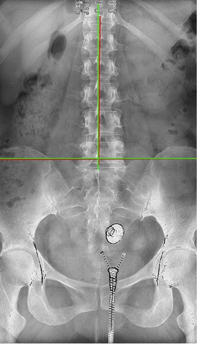 AP lumbar X-ray re-evaluation after one year of corrective spinal care — Rochet Family Chiropractic Royal Palm Beach FL