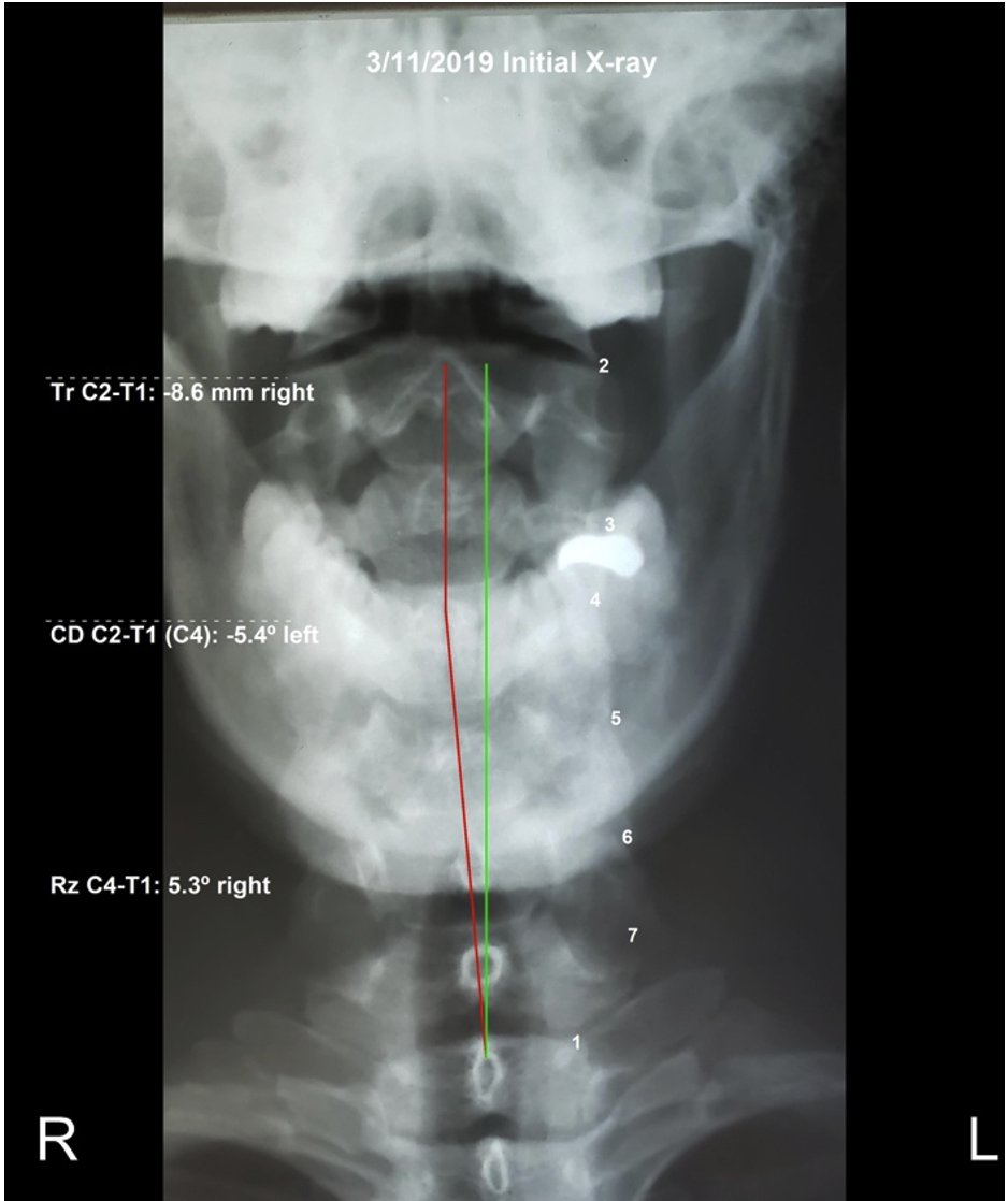 AP cervical X-ray initial showing cervical subluxation — Rochet Family Chiropractic Royal Palm Beach FL