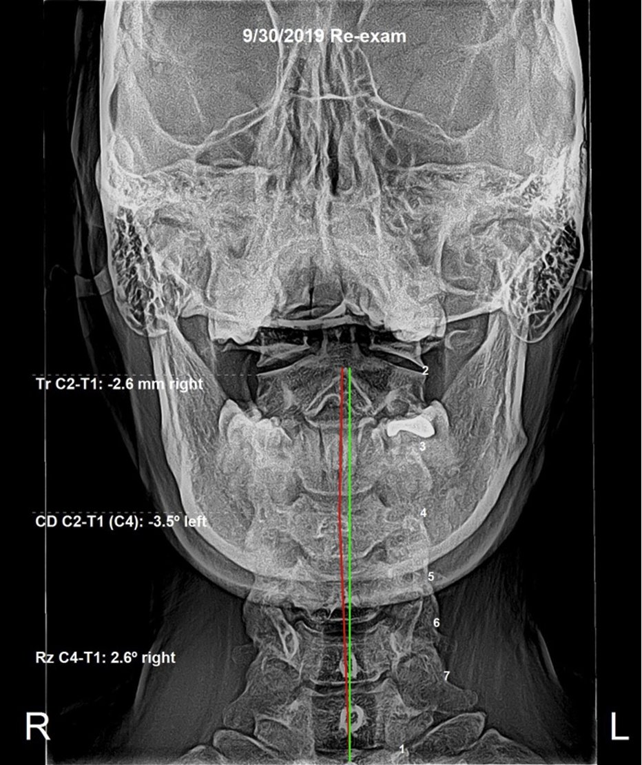 AP cervical X-ray re-evaluation showing near-ideal alignment after 6 months of correction — Rochet Family Chiropractic Royal Palm Beach FL