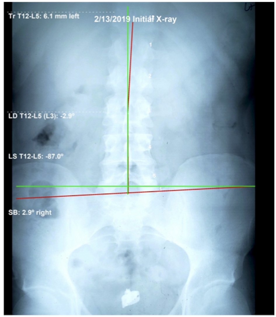 Initial AP lumbar X-ray February 2019 — pelvis severely misaligned, sacral base 2.9° off level, Rochet Family Chiropractic Royal Palm Beach