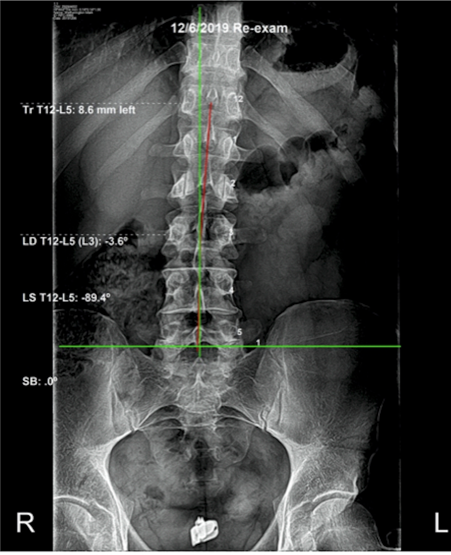 Re-evaluation AP lumbar X-ray December 2019 — sacral base corrected to 0.0°, pelvic alignment restored, Rochet Family Chiropractic Royal Palm Beach