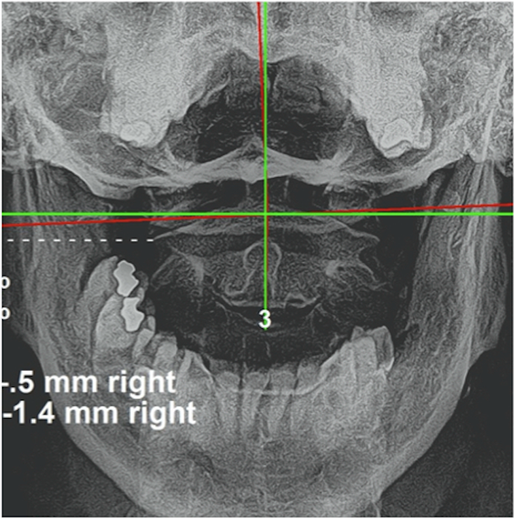Initial AP upper cervical X-ray showing atlas C1 and axis C2 vertebral subluxation with measurable displacement, Royal Palm Beach patient, Rochet Family Chiropractic