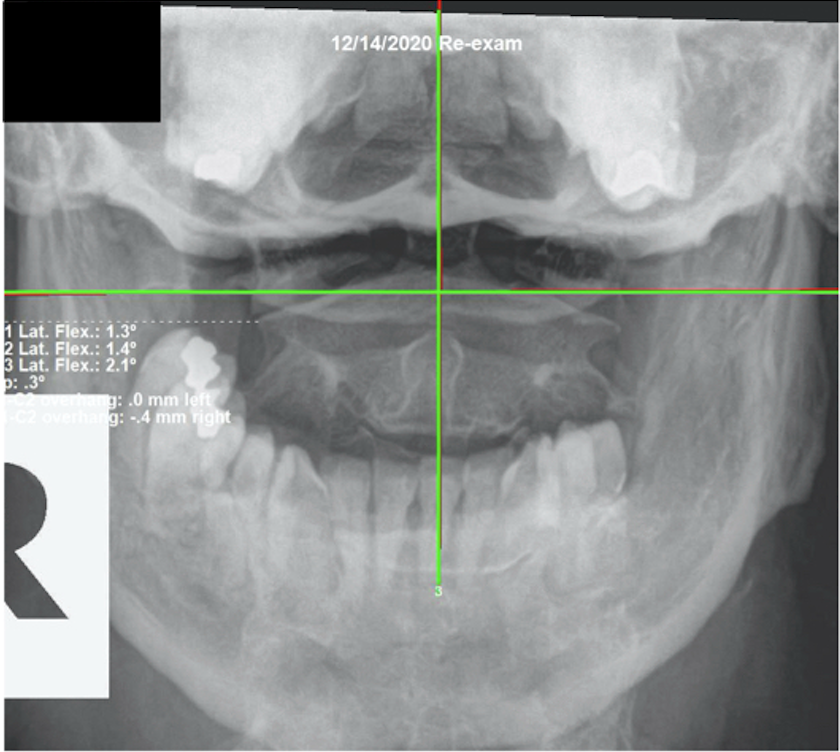 December 14, 2020 re-evaluation AP upper cervical X-ray showing improved C1 and C2 alignment after six months of corrective chiropractic care, Rochet Family Chiropractic Royal Palm Beach