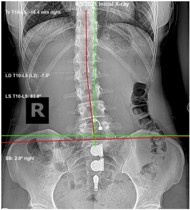 June 9, 2021 initial AP lumbar and pelvic X-ray showing 16.4mm right lateral translation and pelvic subluxation in a 33-year-old female equestrian instructor, Rochet Family Chiropractic Royal Palm Beach