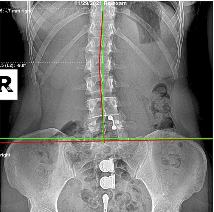 November 29, 2021 re-evaluation AP lumbar and pelvic X-ray showing lateral translation reduced to 0.7mm right after six months of subluxation-based corrective care, Rochet Family Chiropractic Royal Palm Beach
