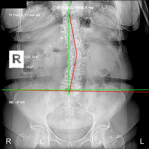 August 15, 2022 initial AP lumbar X-ray showing severe lumbar subluxation spinal deviation in a 76-year-old female, Rochet Family Chiropractic Royal Palm Beach