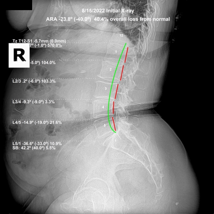 August 15, 2022 initial lateral lumbar X-ray showing reversal of the normal lumbar curve with ARA negative 23.8 degrees and 40.4 percent overall loss from normal, Rochet Family Chiropractic Royal Palm Beach