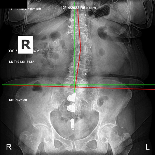 December 14, 2022 re-evaluation AP lumbar X-ray after three months of subluxation-based corrective care showing 42 percent improvement in lumbar angulation, Rochet Family Chiropractic Royal Palm Beach