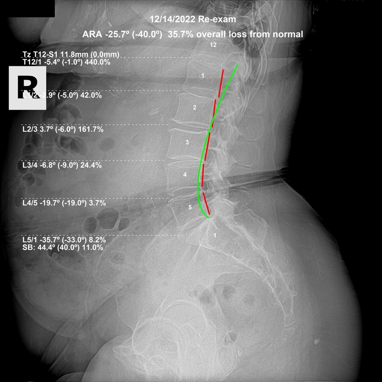 December 14, 2022 re-evaluation lateral lumbar X-ray showing overall loss from normal reduced to 35.7 percent after three months of corrective care, Rochet Family Chiropractic Royal Palm Beach