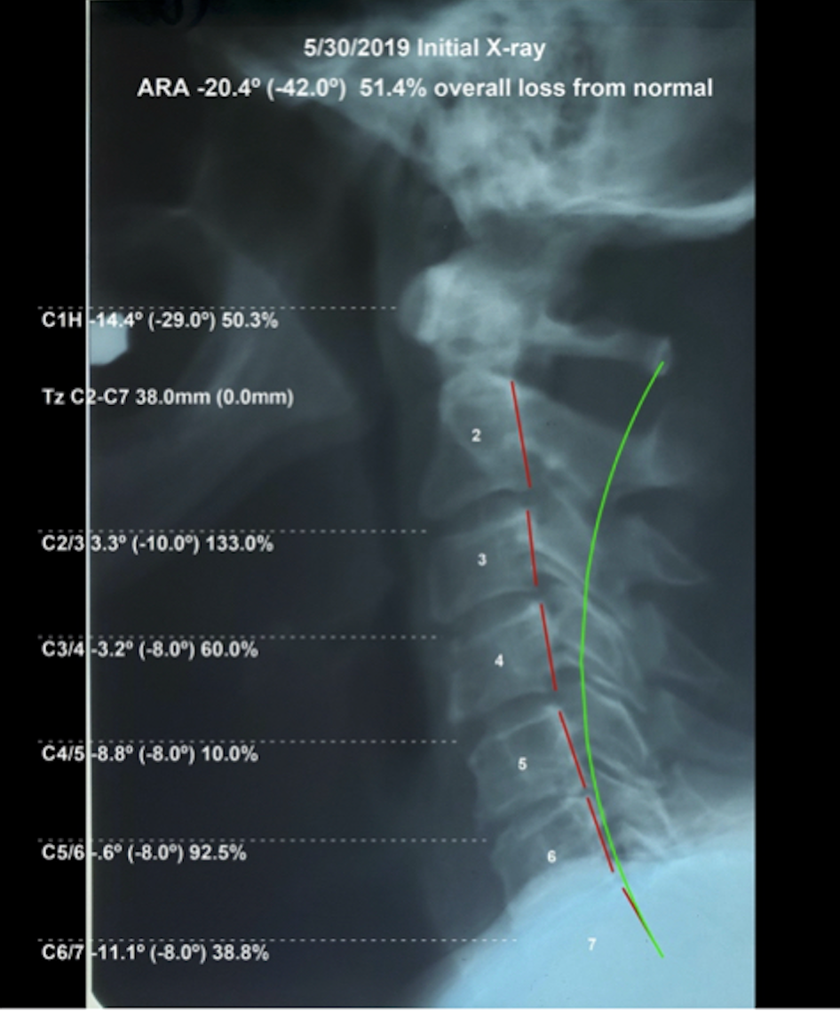 Initial lateral cervical X-ray May 2019 — ARA -20.4 degrees, 51.4% overall cervical curve loss from normal, Rochet Family Chiropractic Royal Palm Beach