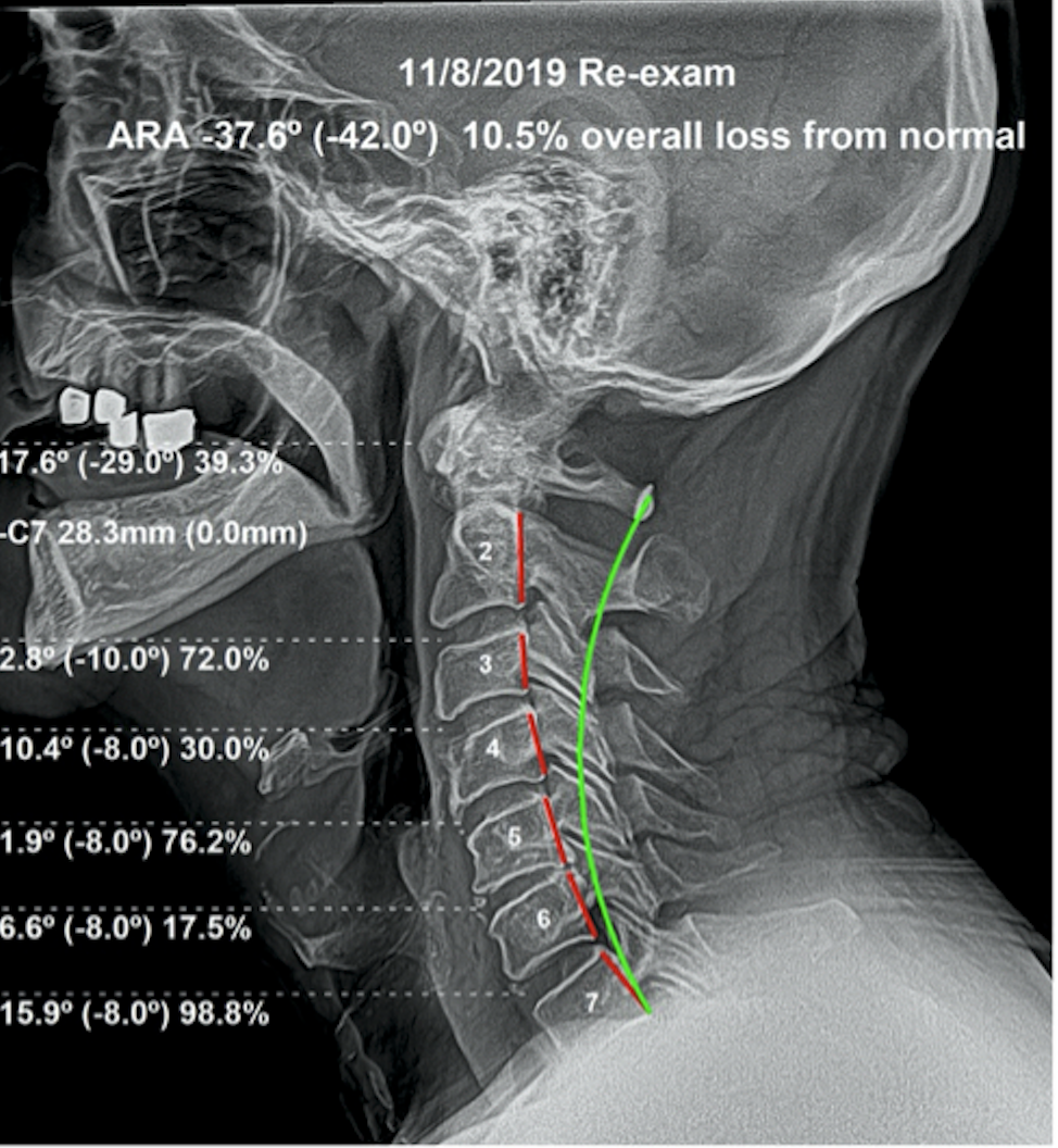 Re-evaluation lateral cervical X-ray November 2019 — ARA -37.6 degrees, only 10.5% overall loss from normal, 54% correction achieved, Rochet Family Chiropractic Royal Palm Beach