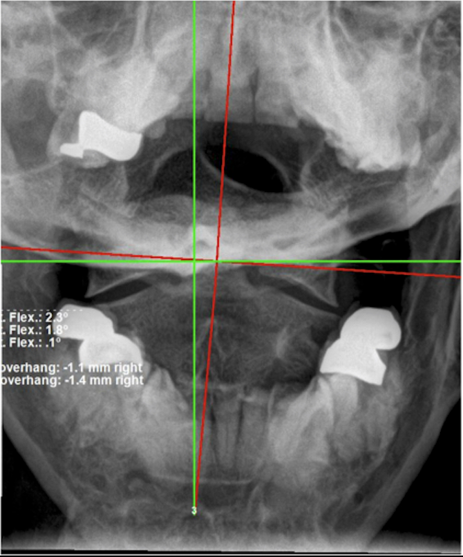 Initial AP upper cervical X-ray showing cervical subluxation in 56-year-old male with prior maintenance chiropractic care history, Rochet Family Chiropractic Royal Palm Beach