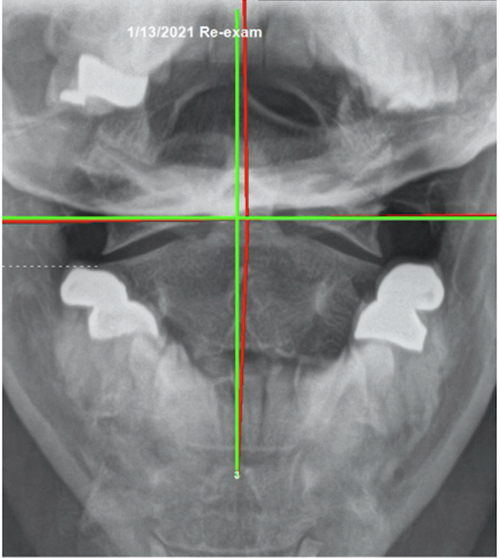 January 13, 2021 re-evaluation AP upper cervical X-ray showing improved atlas alignment after committed second corrective care plan, Rochet Family Chiropractic Royal Palm Beach