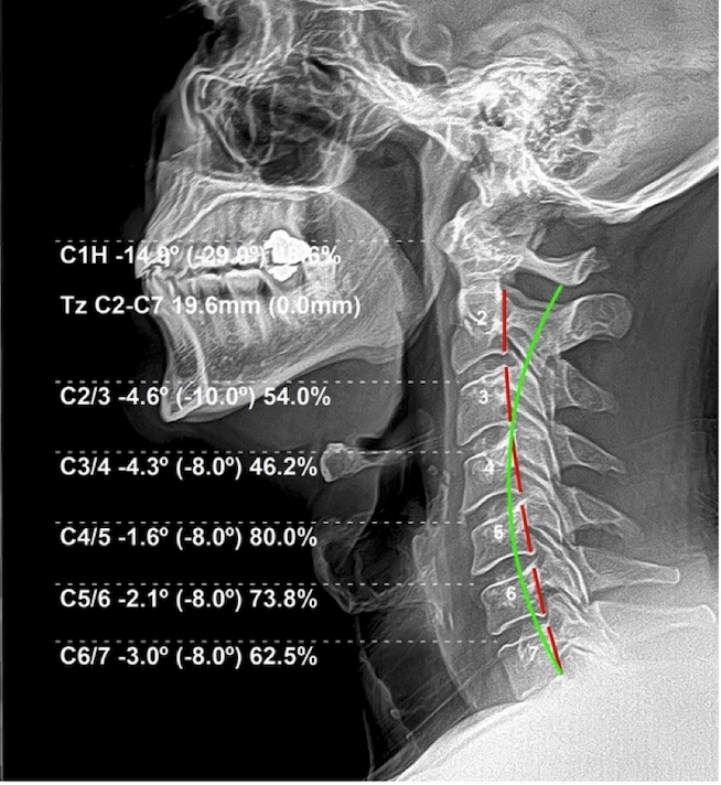 Initial lateral cervical X-ray of a 38-year-old male DJ showing loss of the normal cervical curve and segmental subluxation, Rochet Family Chiropractic Royal Palm Beach