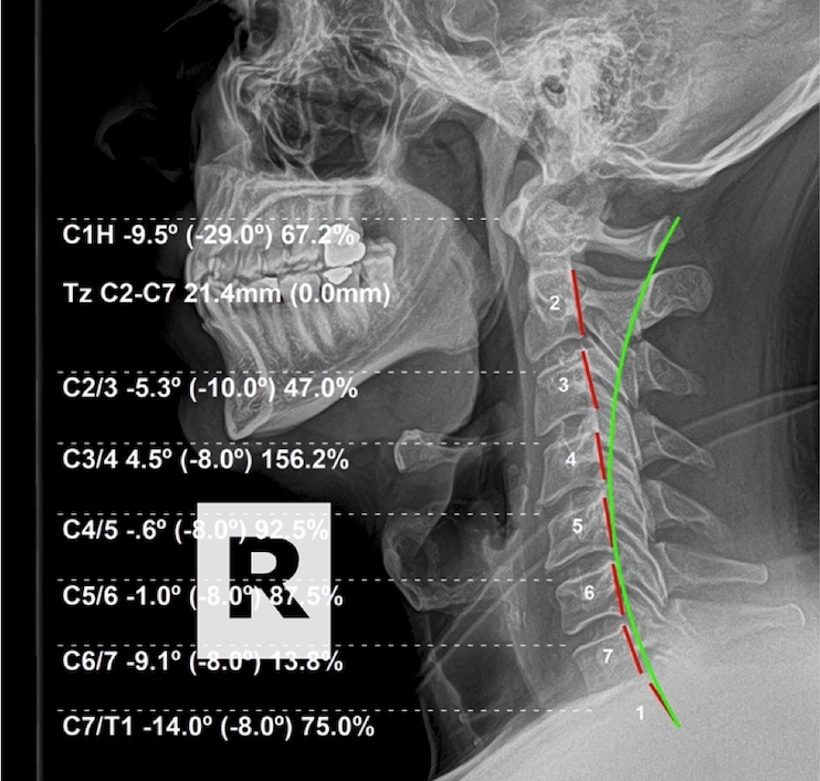 Interim re-evaluation lateral cervical X-ray showing restored curve in the lower neck after three months of subluxation-based corrective care, Rochet Family Chiropractic Royal Palm Beach