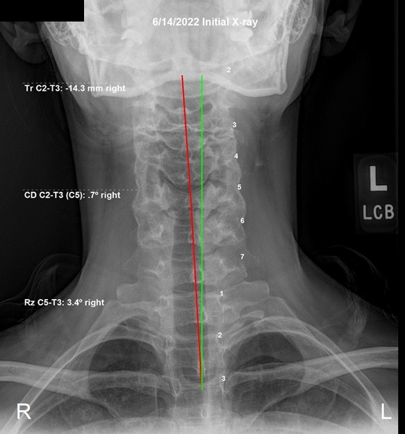 June 14, 2022 initial AP cervical X-ray showing a listing to the right worsening into the upper cervical spine, Rochet Family Chiropractic Royal Palm Beach