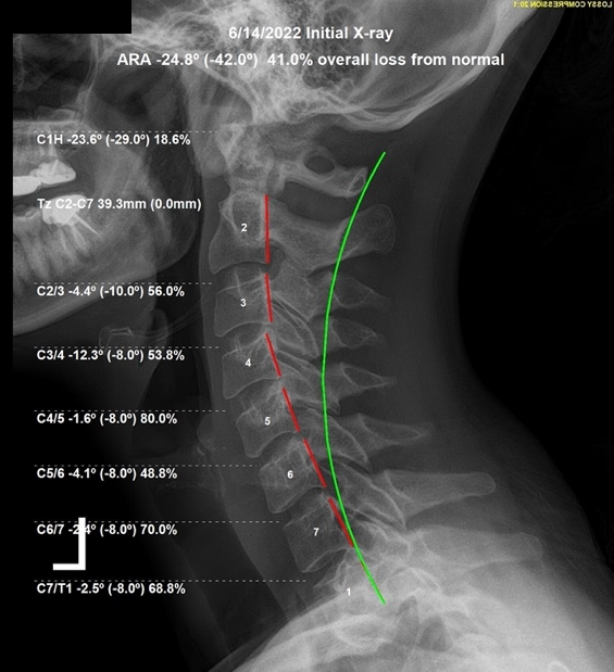 June 14, 2022 initial lateral cervical X-ray showing straightened cervical lordosis and ligamentous laxity at C3/C4 in a 44-year-old female, Rochet Family Chiropractic Royal Palm Beach