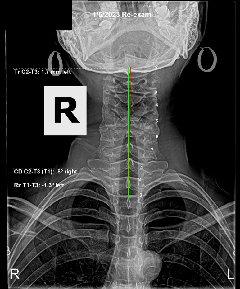 January 6, 2023 re-evaluation AP cervical X-ray showing significant correction of the spine back toward vertical, Rochet Family Chiropractic Royal Palm Beach