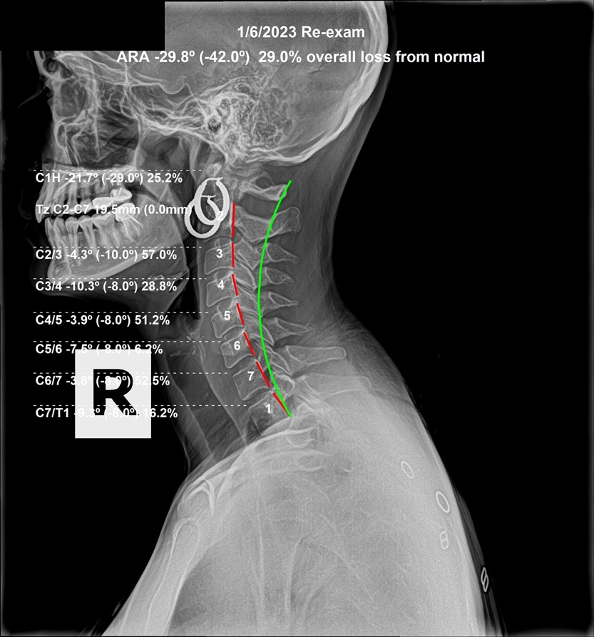 January 6, 2023 re-evaluation lateral cervical X-ray showing drastically improved cervical lordosis after six months of subluxation-based corrective care, Rochet Family Chiropractic Royal Palm Beach