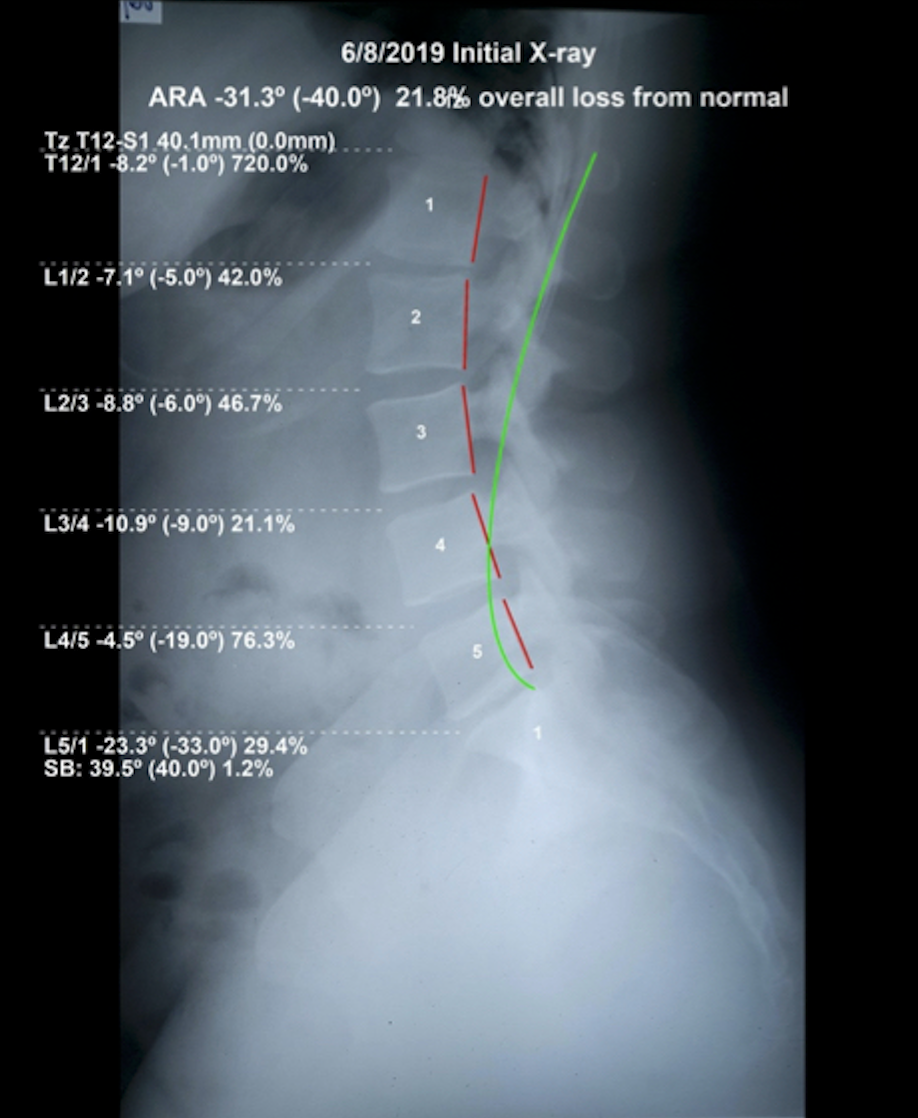 Initial lateral lumbar X-ray June 2019 — ARA -31.3 degrees, 21.8% overall lumbar curve loss from normal, low back pain radiating to legs, Rochet Family Chiropractic Royal Palm Beach