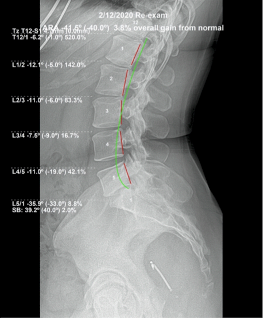 Re-evaluation lateral lumbar X-ray February 2020 — lumbar lordosis corrected to -41.5 degrees, surpassing normal, 125% overall correction achieved, Rochet Family Chiropractic Royal Palm Beach