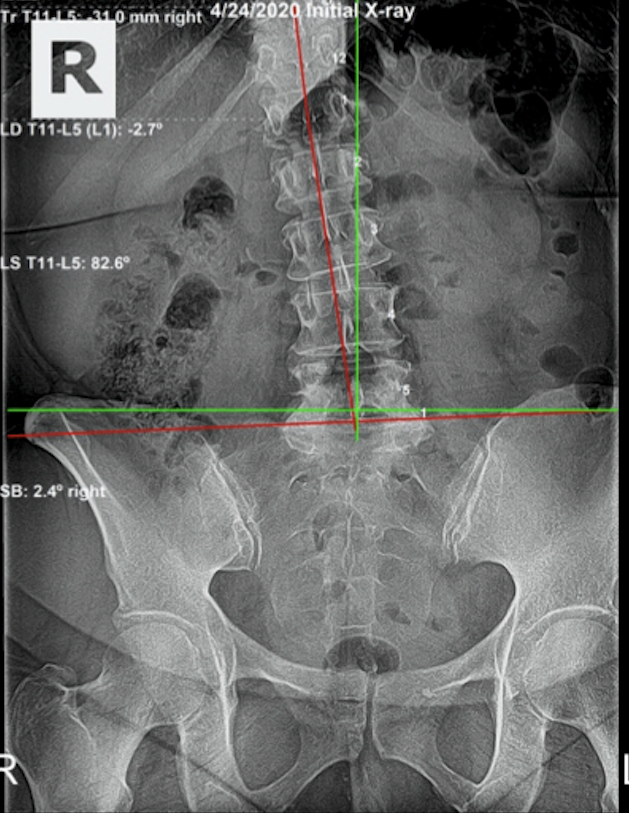 April 24, 2020 initial AP lumbar and pelvic X-ray showing significant lumbar subluxation and pelvic tilt in 53-year-old female with sciatica-type presentation, Rochet Family Chiropractic Royal Palm Beach