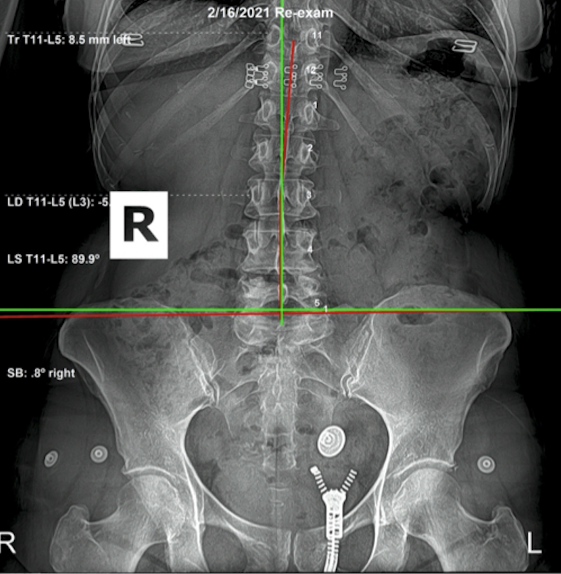 February 16, 2021 re-evaluation AP lumbar and pelvic X-ray showing significant improvement in lumbar and pelvic alignment after subluxation-based corrective care, Rochet Family Chiropractic Royal Palm Beach