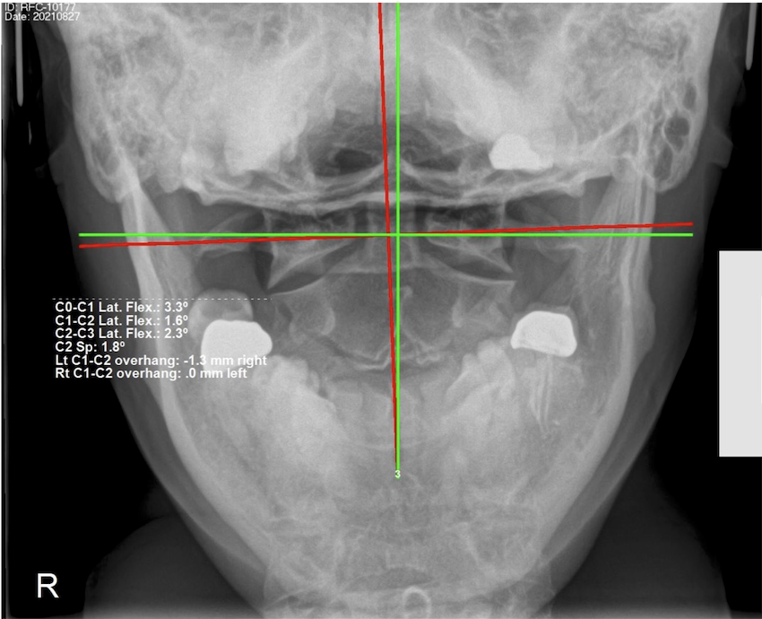 Initial APOM open-mouth upper cervical X-ray of a 57-year-old male showing Atlas subluxation and head tilt with C0-C1 lateral flexion of 3.3 degrees, Rochet Family Chiropractic Royal Palm Beach