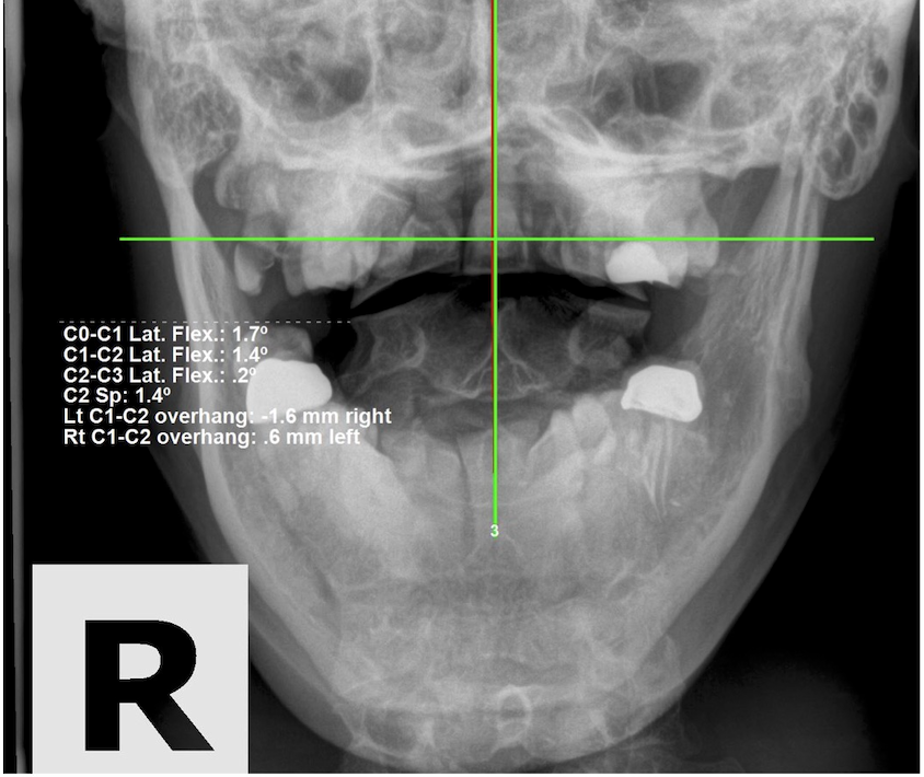 Re-evaluation APOM open-mouth upper cervical X-ray showing improved Atlas alignment with C0-C1 lateral flexion reduced to 1.7 degrees after subluxation-based corrective care, Rochet Family Chiropractic Royal Palm Beach