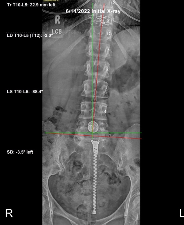 June 14, 2022 initial AP lumbar X-ray showing severe listing to the right with pelvic rotation of the sacrum in a 44-year-old female, Rochet Family Chiropractic Royal Palm Beach