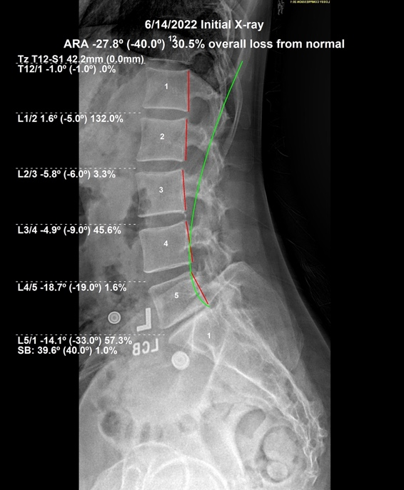 June 14, 2022 initial lateral lumbar X-ray showing straightened lumbar curvature with reversal at L1 L2 and a degenerated L5 disc, Rochet Family Chiropractic Royal Palm Beach